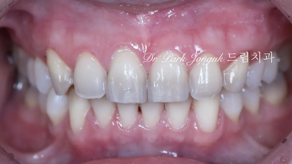 Minimal reduction for the veneers