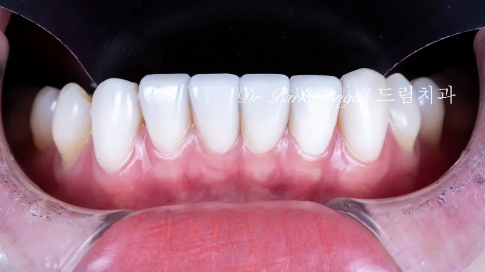 Veneer treatment that fully corrected the shape and discoloration