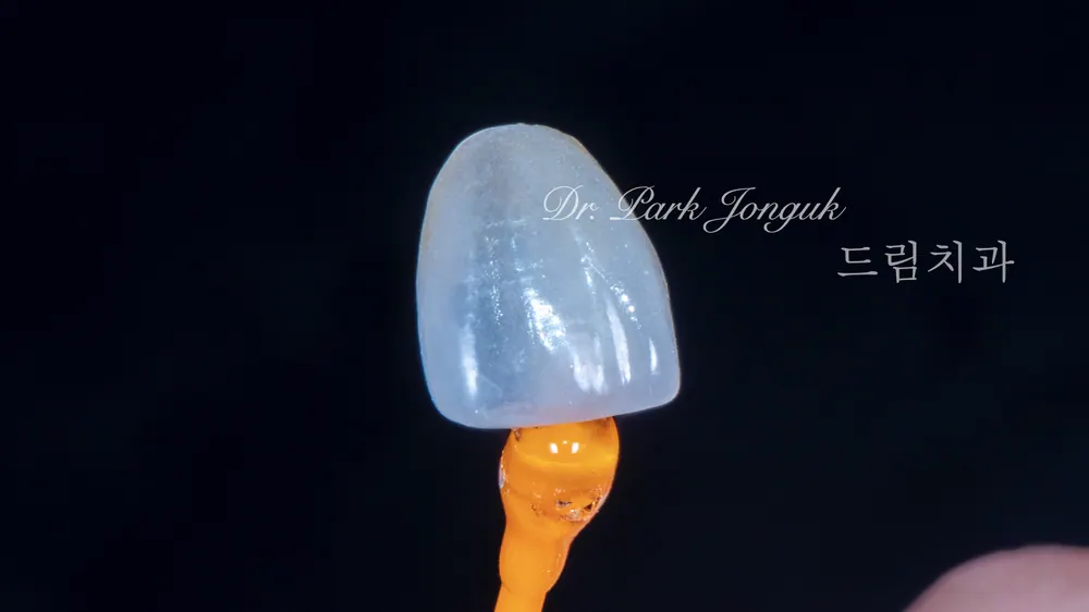 50대에도 가능한 자연스러운 무삭제 라미네이트｜삭제 없이 젊어진 미소 본문 사진 8