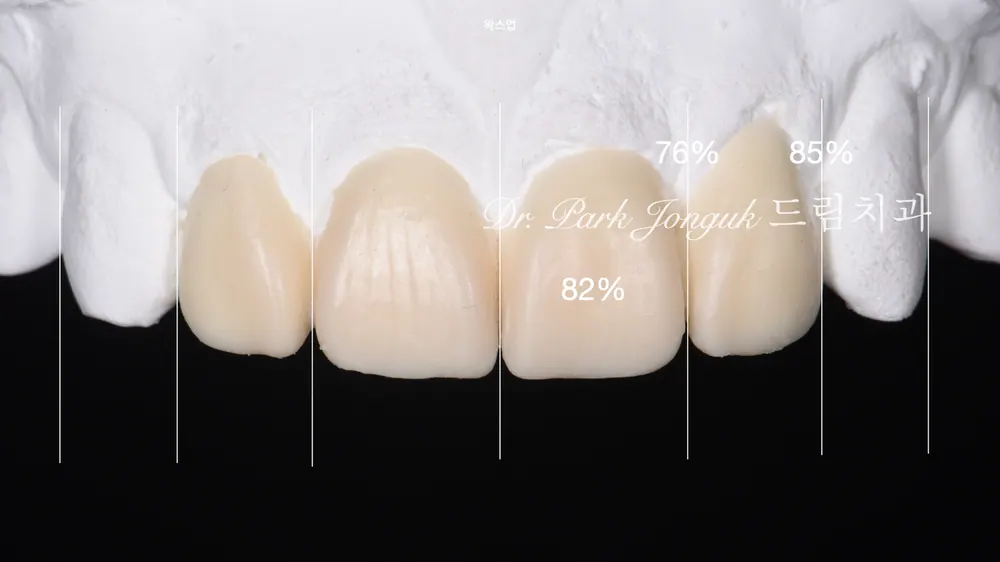 역류성 식도염 환자의 무삭제 라미네이트 치료｜치아 손상을 최소화한 샌드위치 테크닉 본문 사진 6