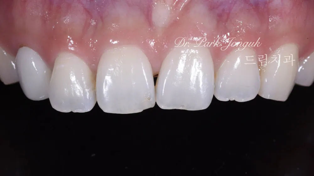 Came in for front teeth veneers