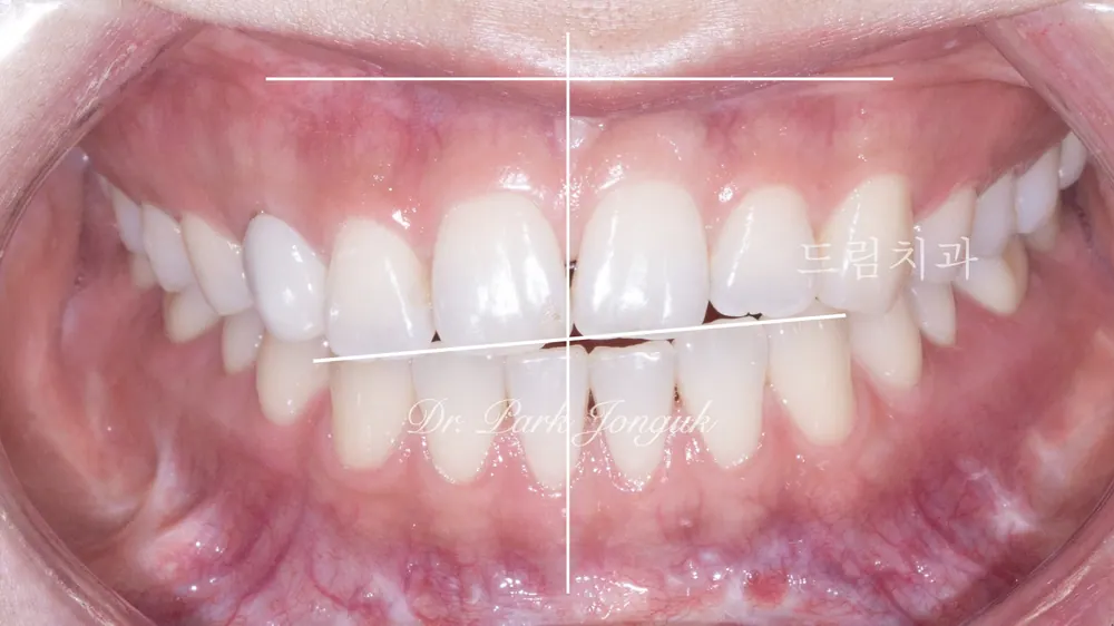 Came in for veneers because the retainer wasn't worn after orthodontic treatment