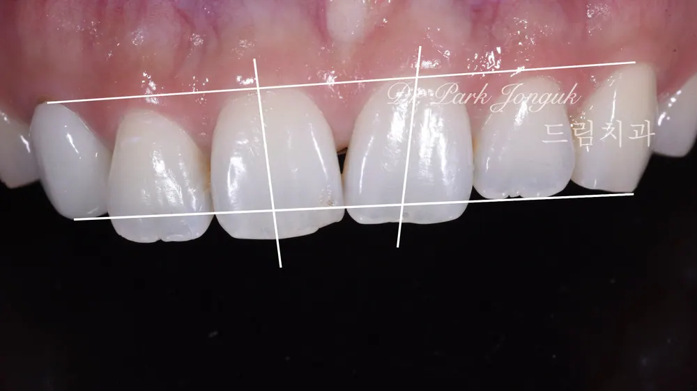 Precise wax-up diagnosis for the front teeth veneers