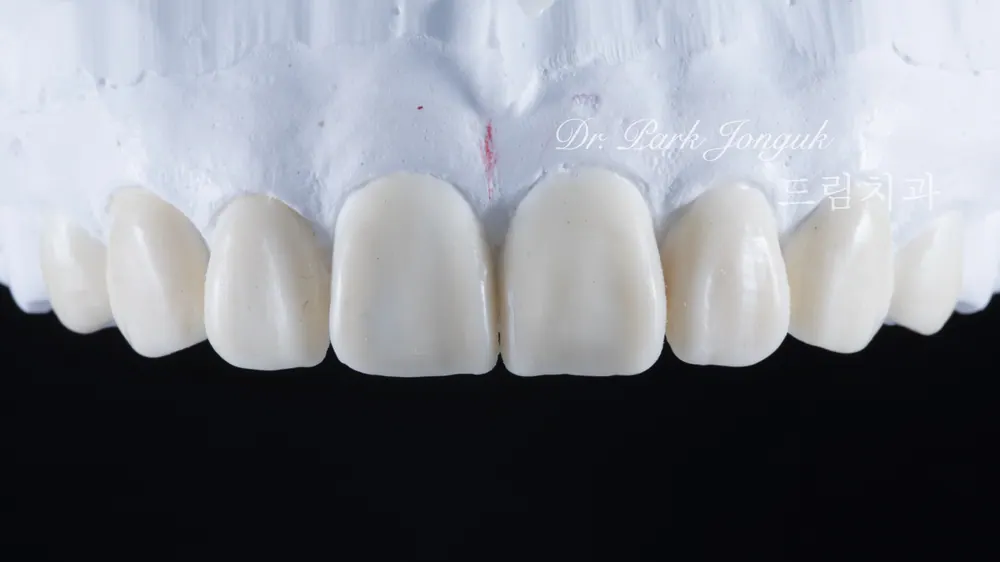 What If Your Front Teeth Shifted Again After Braces? | Front Teeth Veneers That Restored a Balanced Smile — photo 4