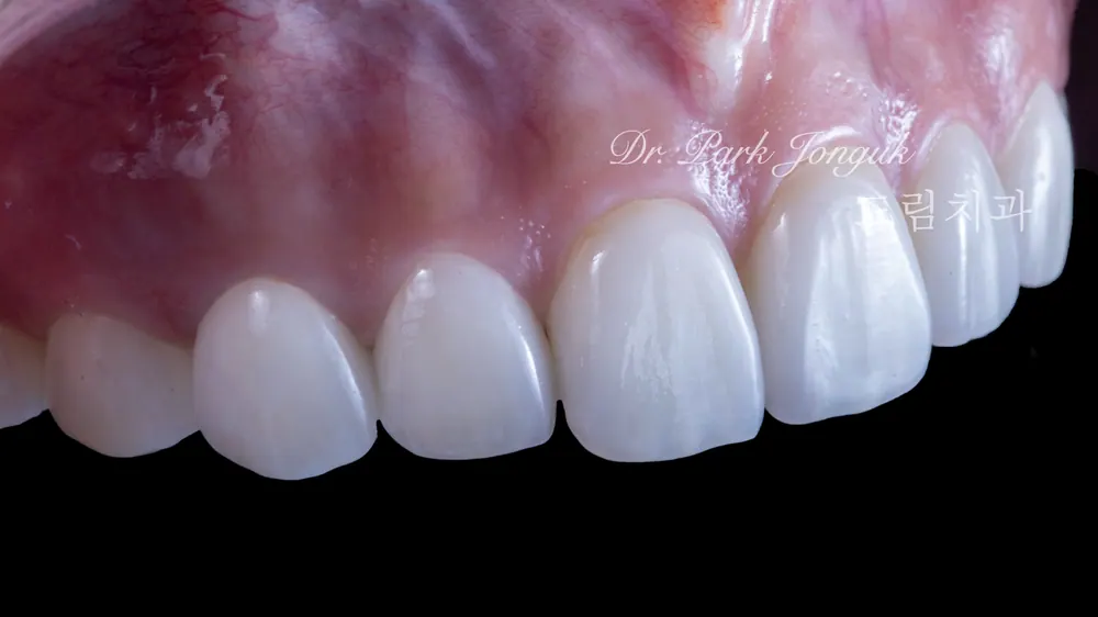 Beautiful, natural front teeth veneers