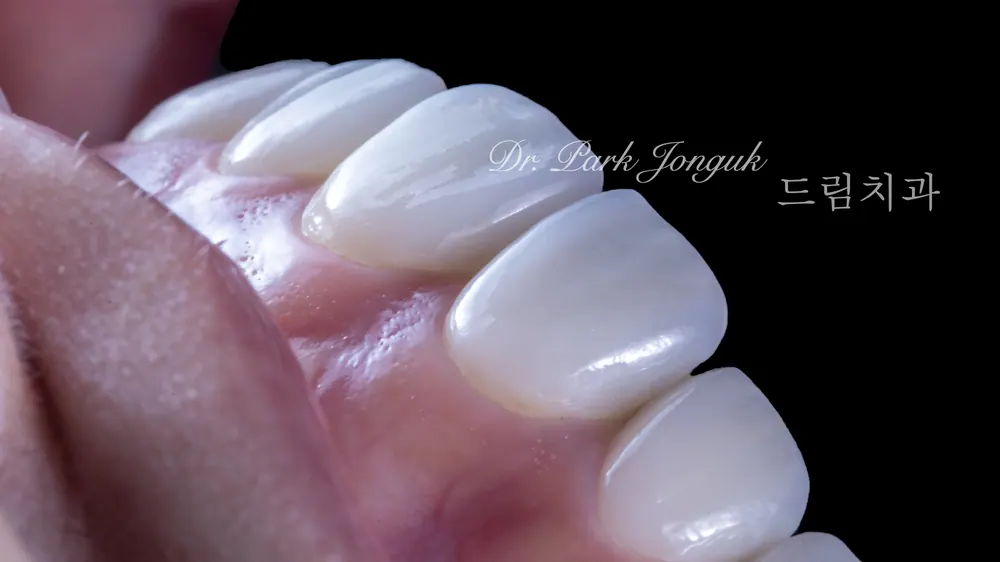 Beautiful, natural front teeth veneers