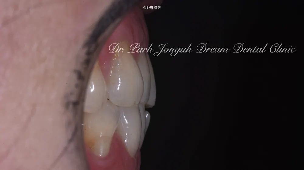 A 60s Woman's Front-Tooth Black Triangles, Naturally Resolved with Veneers — photo 3
