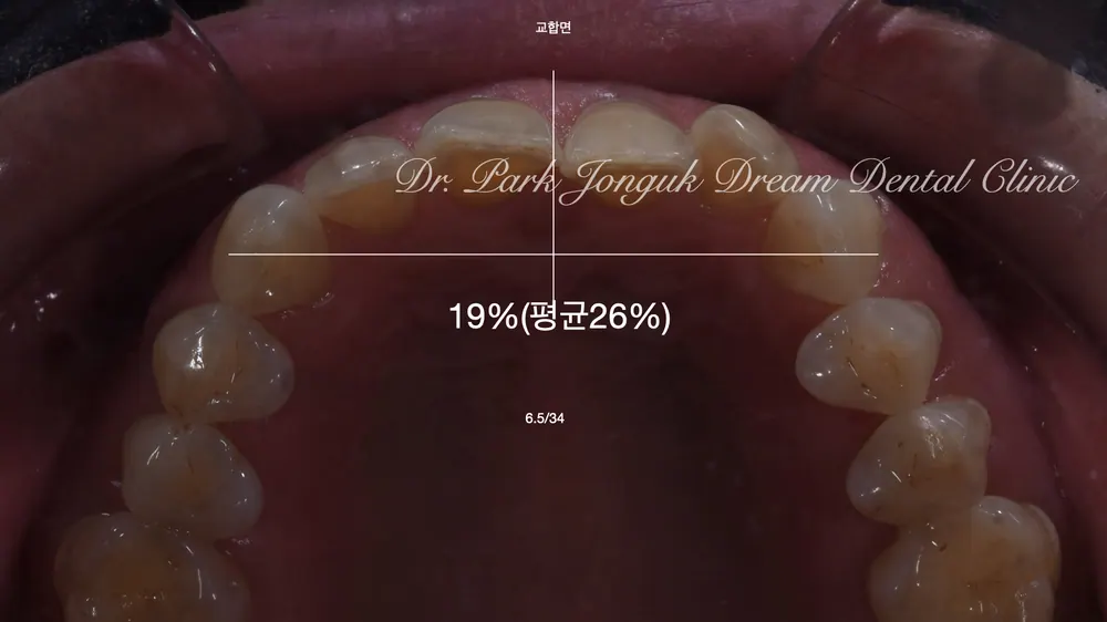 The patient visited for veneer treatment of black triangles