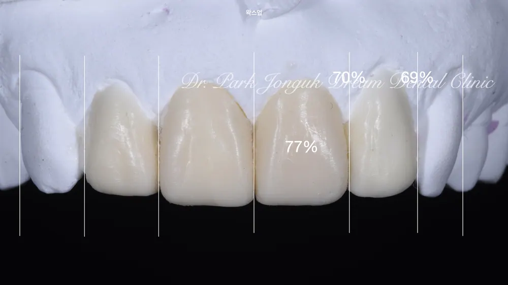 A 60s Woman's Front-Tooth Black Triangles, Naturally Resolved with Veneers — photo 5