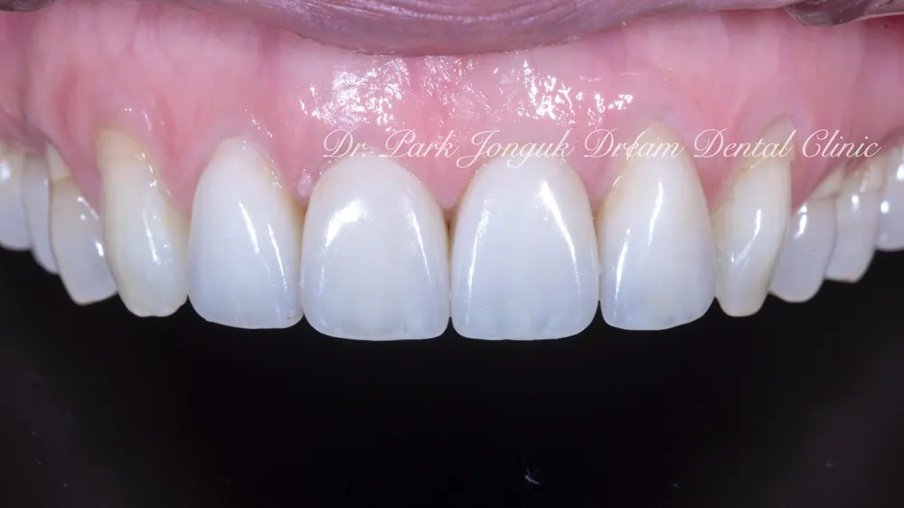 Veneer treatment for black triangles