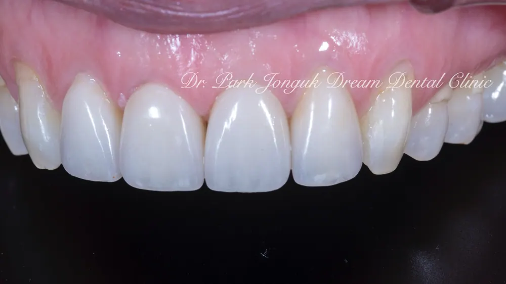 Veneer treatment for black triangles