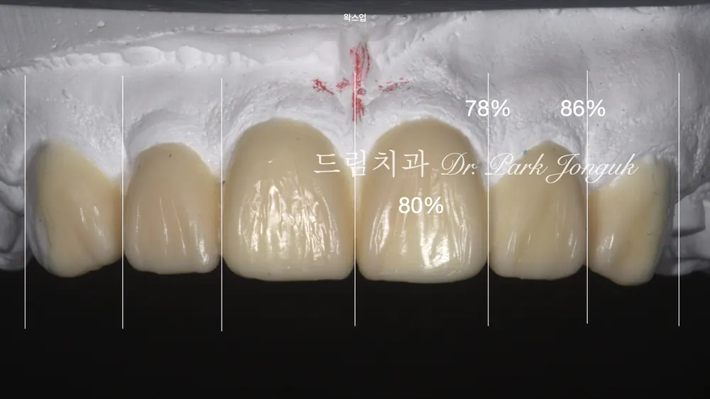 왜소치 치아벌어짐 무삭제 라미네이트