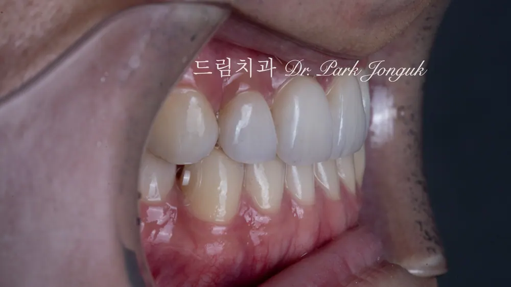 왜소치 치아벌어짐 무삭제 라미네이트