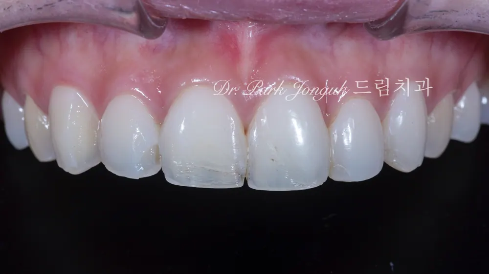 Veneer retreatment