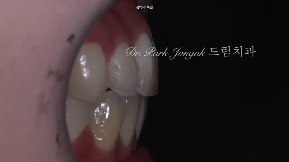 Retreatment After One-Day Veneer Failure: Safe Removal with a Laser — photo 3