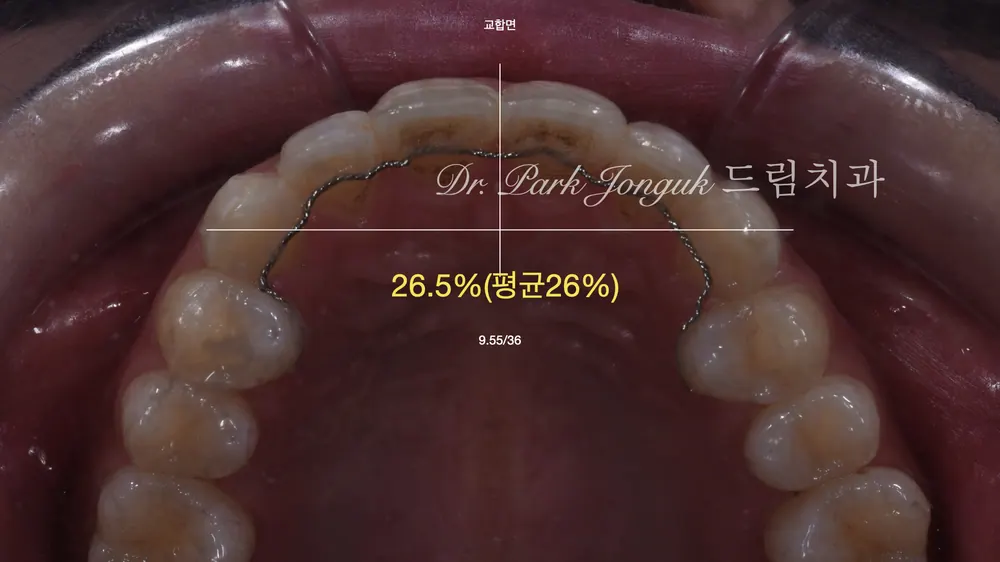 Veneer retreatment