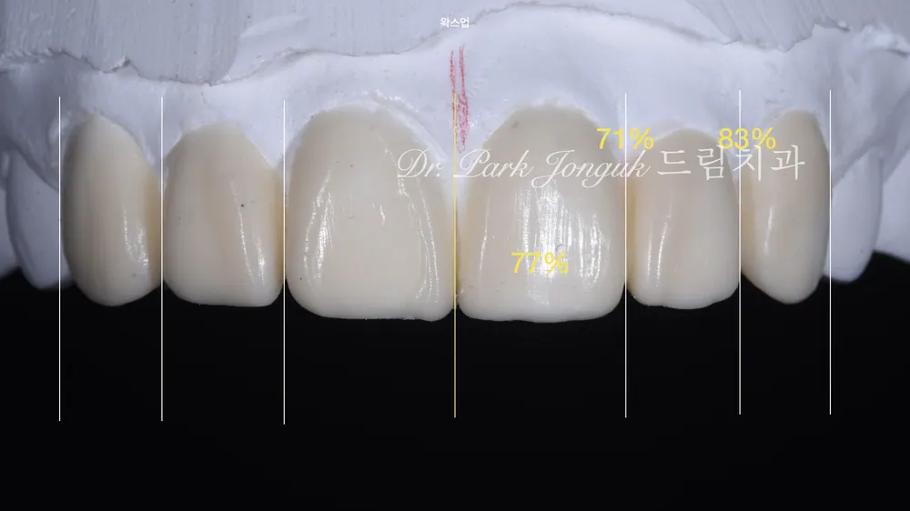 Retreatment After One-Day Veneer Failure: Safe Removal with a Laser — photo 5