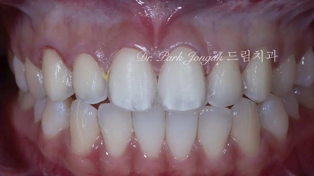 Veneer retreatment