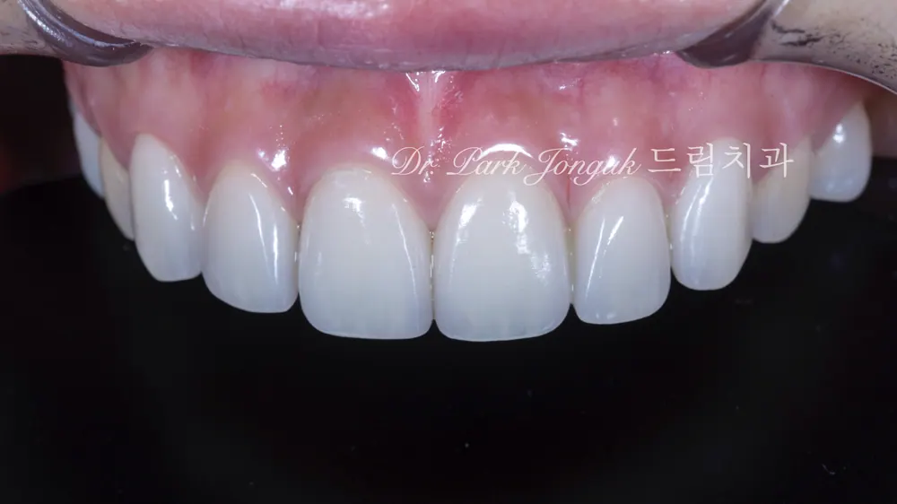 Veneer retreatment