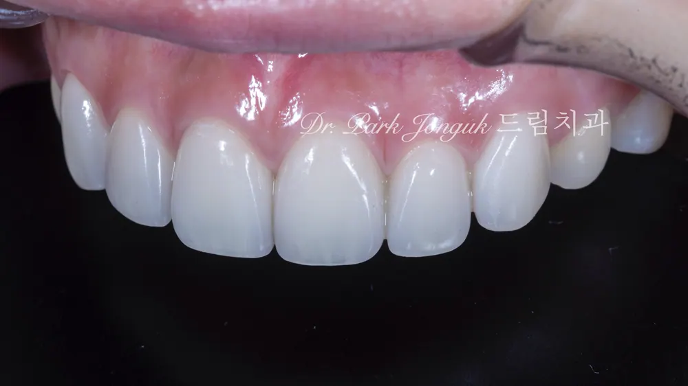 Veneer retreatment