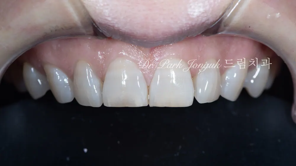 Dán sứ Veneer răng cửa