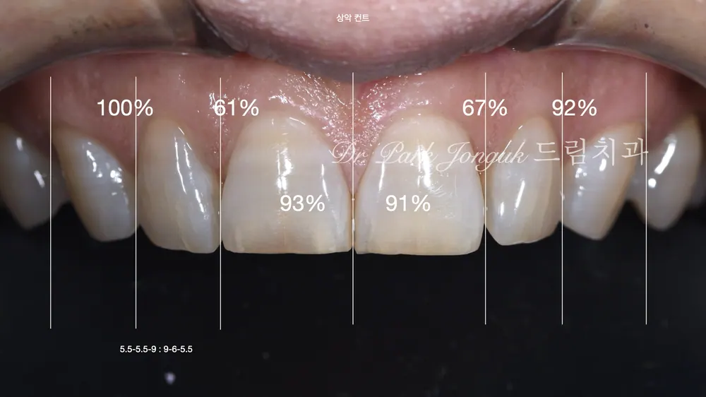 Dán sứ Veneer răng cửa