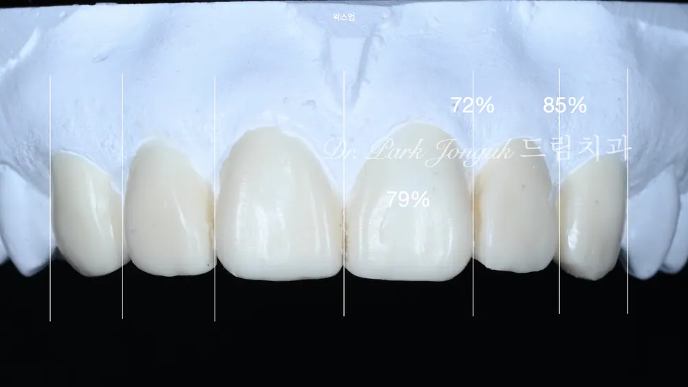 Dán sứ Veneer răng cửa
