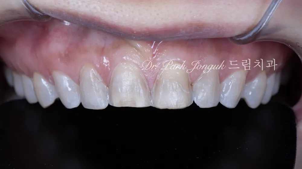 Dán sứ Veneer răng cửa