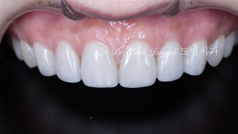 Dán sứ Veneer răng cửa