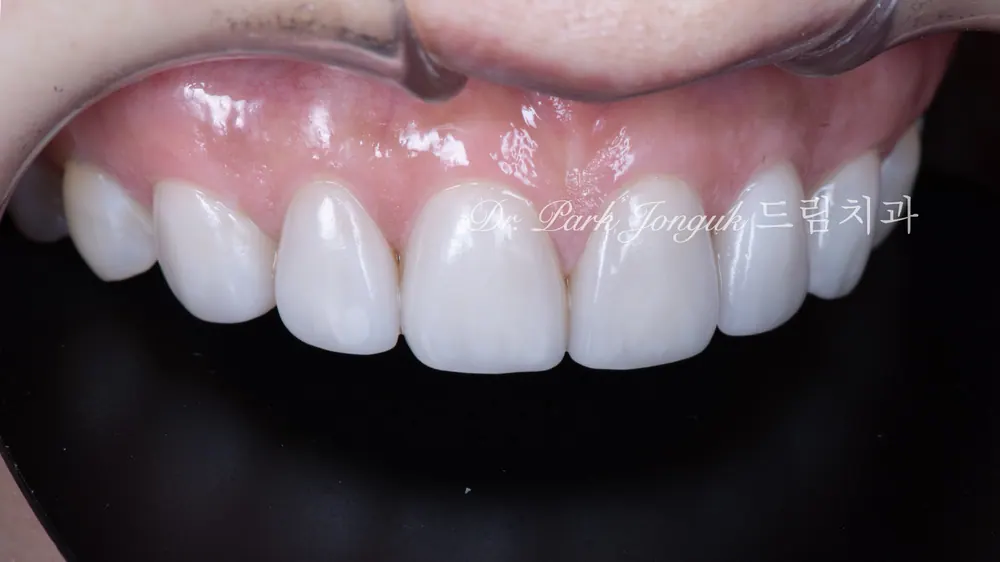 Dán sứ Veneer răng cửa