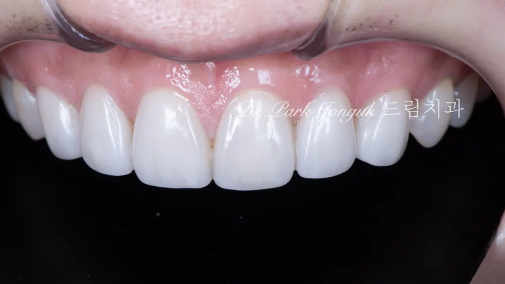 Dán sứ Veneer răng cửa