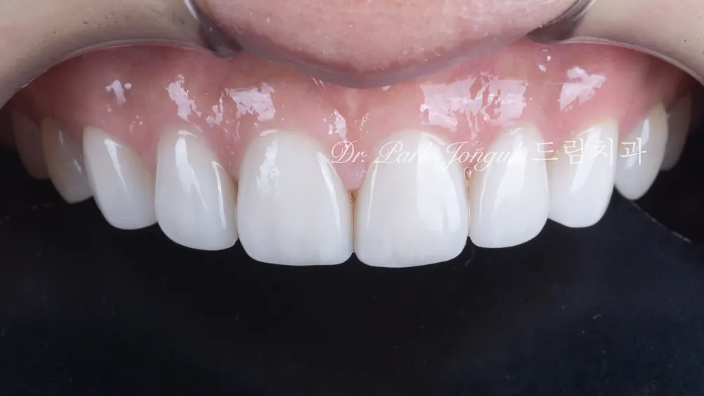 Dán sứ Veneer răng cửa