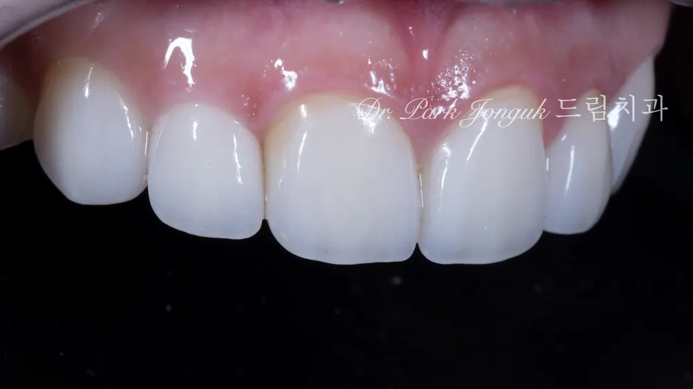 วีเนียร์สำหรับฟันเล็กผิดรูป