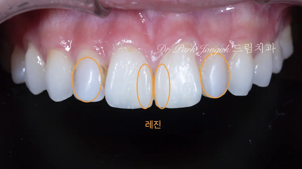 앞니 레진 변색 라미네이트