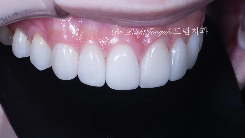 앞니 레진 변색 라미네이트