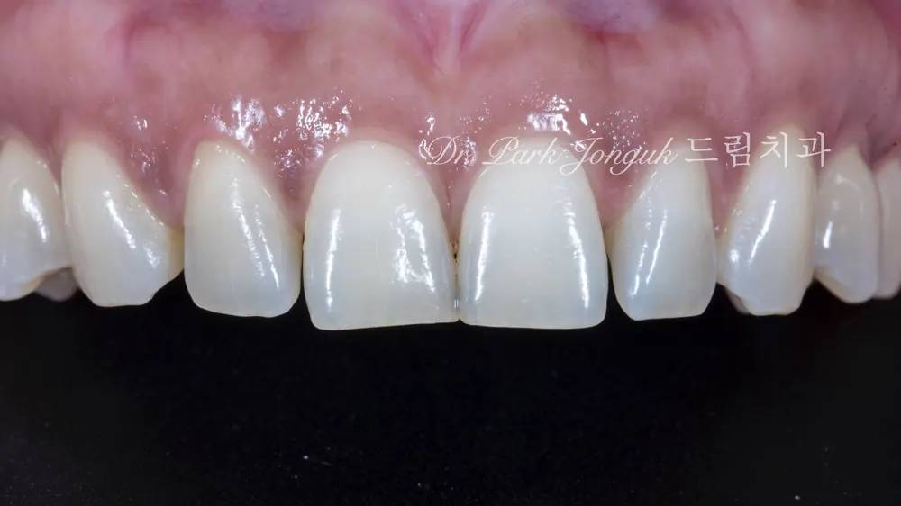 Dán sứ Veneer cho răng cửa bị thưa