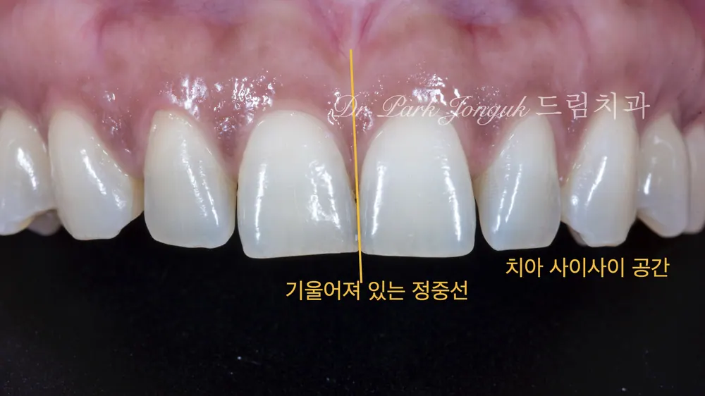 Dán sứ Veneer cho răng cửa bị thưa