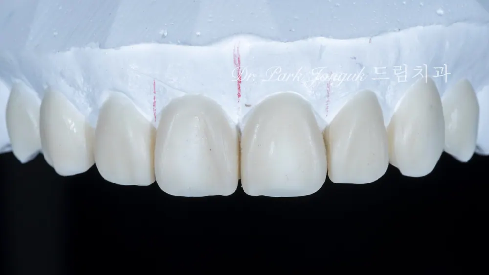 Dán sứ Veneer cho răng cửa bị thưa