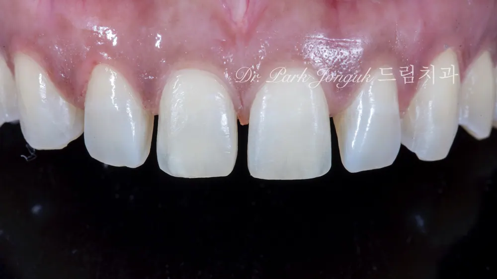 Dán sứ Veneer cho răng cửa bị thưa