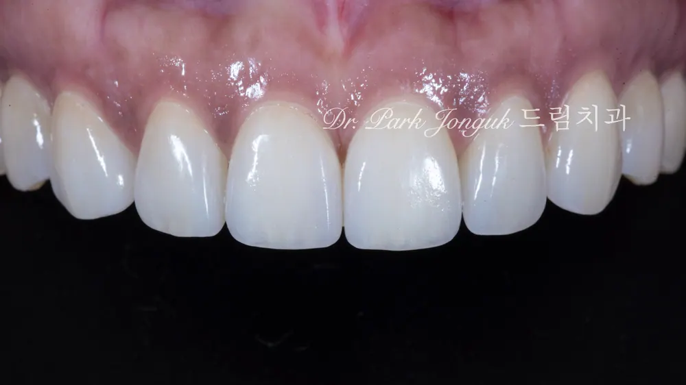 Dán sứ Veneer cho răng cửa bị thưa