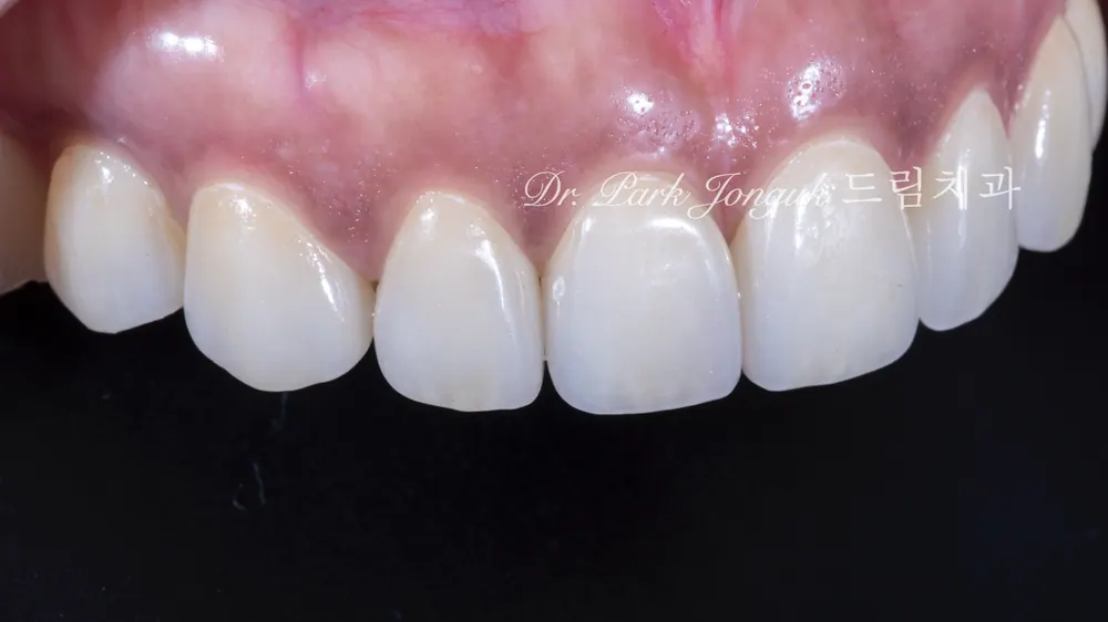 Dán sứ Veneer cho răng cửa bị thưa