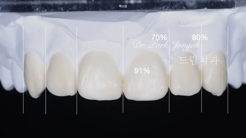 畸形小牙 免磨牙陶瓷貼片