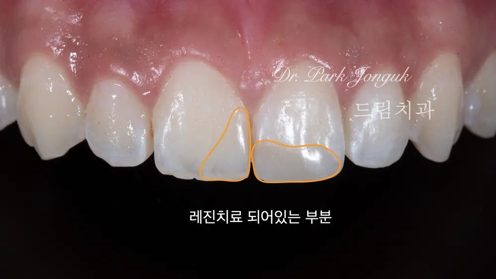 การทำวีเนียร์ใหม่ทับเรซินฟันหน้าที่คังนัม