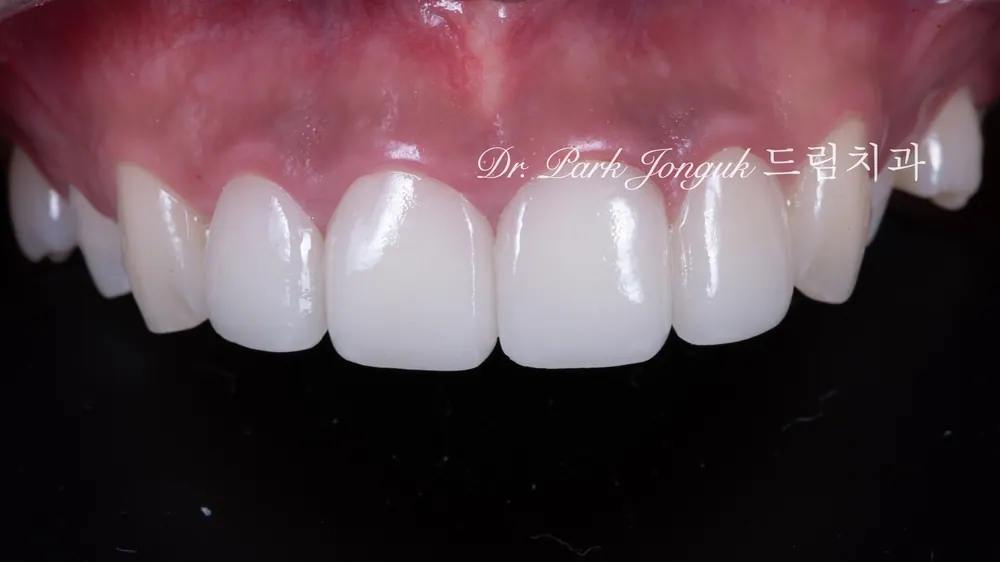 Làm lại veneer sứ răng cửa