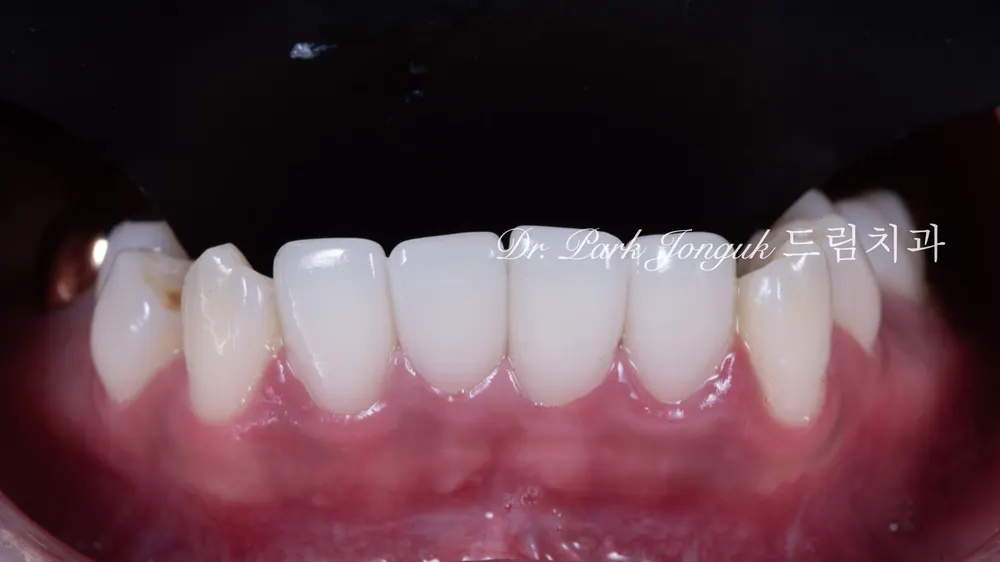 Làm lại veneer sứ: quý khách có biết bẫy của veneer sứ một ngày? — ảnh 3