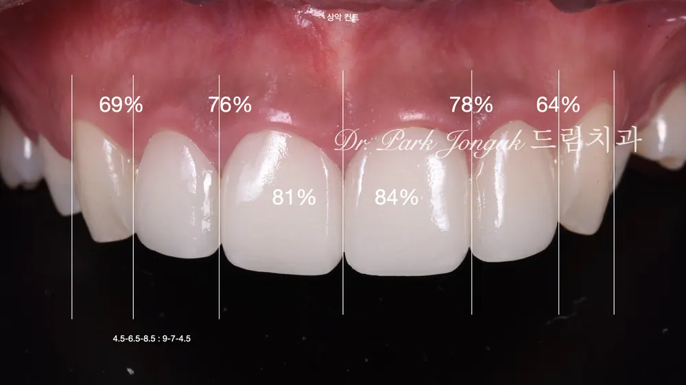 Làm lại veneer sứ răng cửa