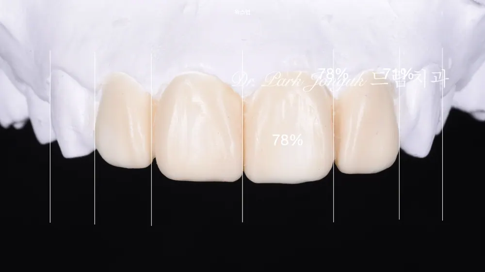 Làm lại veneer sứ răng cửa