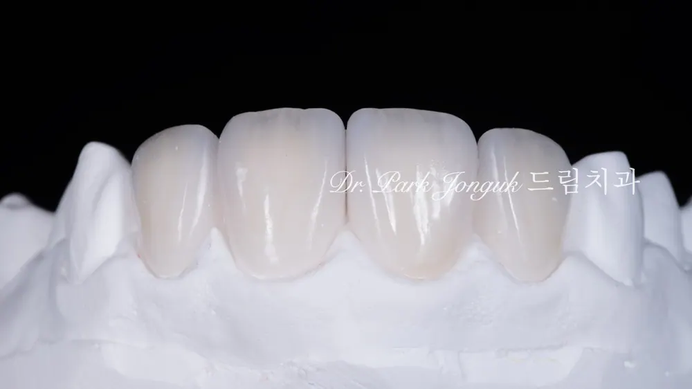 Làm lại veneer sứ răng cửa