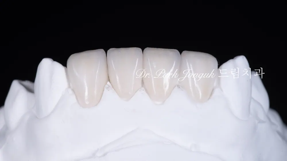 Làm lại veneer sứ răng cửa