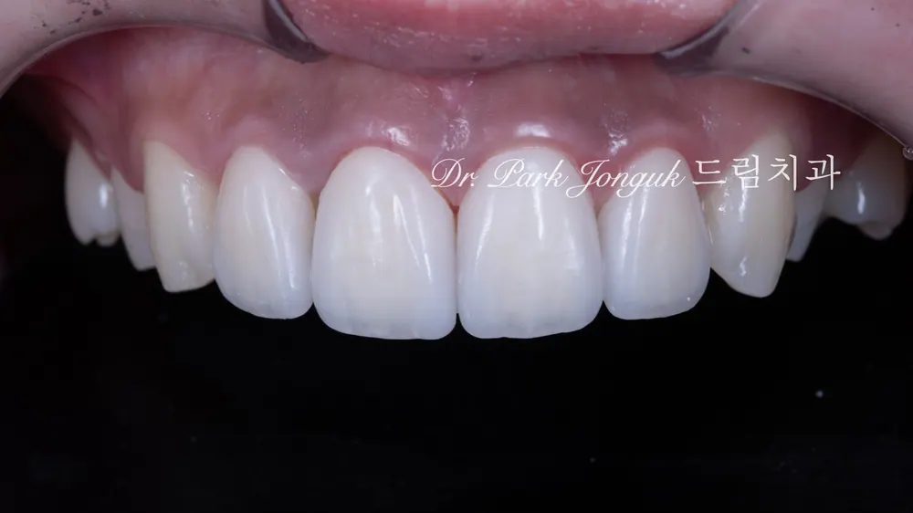 Làm lại veneer sứ răng cửa